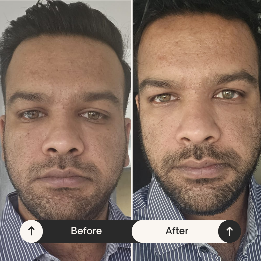 Client before and after — skin healing